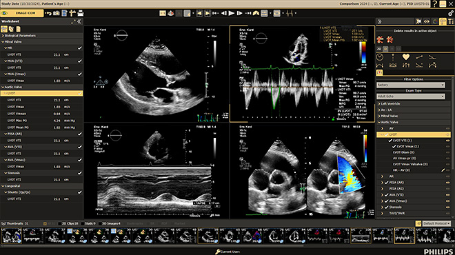 心エコー画像解析システム Ultrasound Workspace